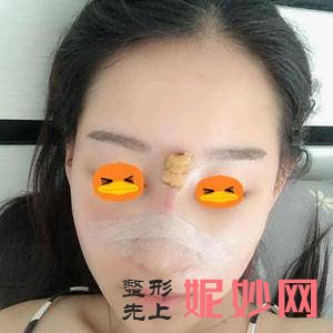 贵阳利美康整形外科医院梁安裕医生技术好不好_玻尿酸丰泪沟技术好不好