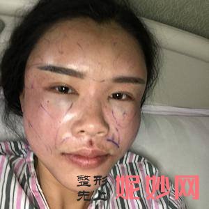 广州紫馨医疗美容医院洪星杓医生怎么样_精灵耳矫正怎么样