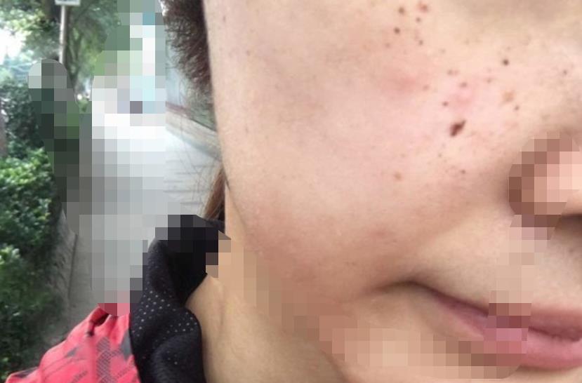 m22和皮秒哪个好？两者功效作用一样吗？附m22案例和价格表！