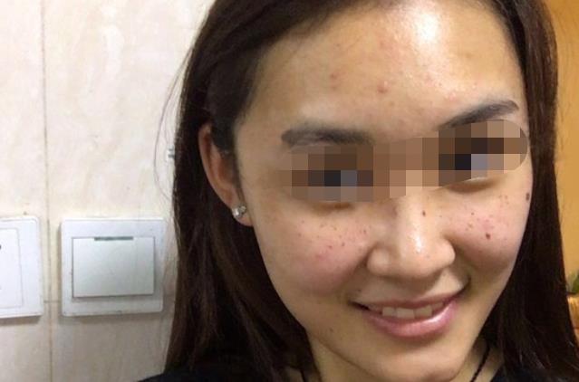 m22和皮秒哪个好？两者功效作用一样吗？附m22案例和价格表！