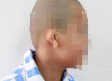 做整形耳朵大概要多少钱？整形耳朵前后效果对比，附较新价格表！