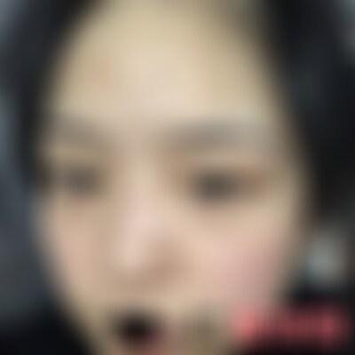 柳州华美祛痘怎么样
