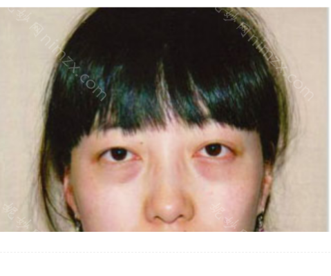 广州家庭医生整形医院赵成利做祛眼袋怎么样?附术后恢复效果图+价格表