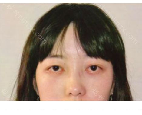 广州家庭医生整形医院赵成利做祛眼袋怎么样?附术后恢复效果图+价格表
