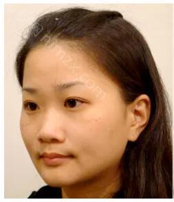 南京艺星医疗整形美容医院潘峰做鼻子效果怎么样?附医生简介_案例_价格表