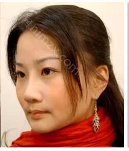 南京艺星医疗整形美容医院潘峰做鼻子效果怎么样?附医生简介_案例_价格表