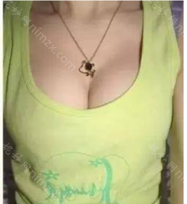 杭州艺星医疗美容医院万连壮做隆胸效果怎么样?附真人案例效果图