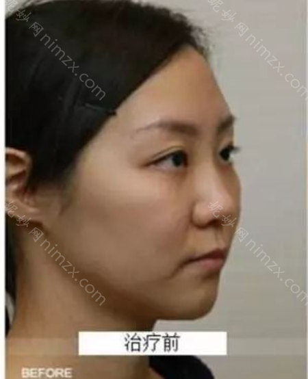 杭州艺星医疗美容医院孙林潮做热玛吉效果如何?附术后效果对比图+价格