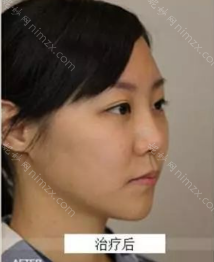 杭州艺星医疗美容医院孙林潮做热玛吉效果如何?附术后效果对比图+价格