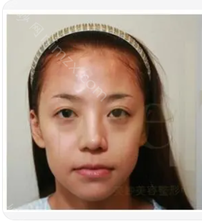杭州艺星医疗美容医院李俊霞做面部提升效果好不好?附术后效果对比图+价格表