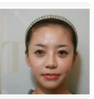 杭州艺星医疗美容医院李俊霞做面部提升效果好不好?附术后效果对比图+价格表