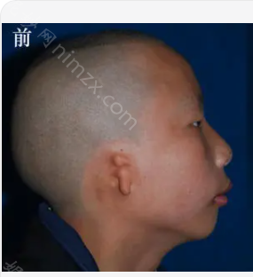 耳朵再造较好的医院是哪家?附真人耳朵整形案例，快来看看吧