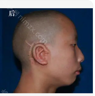 耳朵再造较好的医院是哪家?附真人耳朵整形案例，快来看看吧