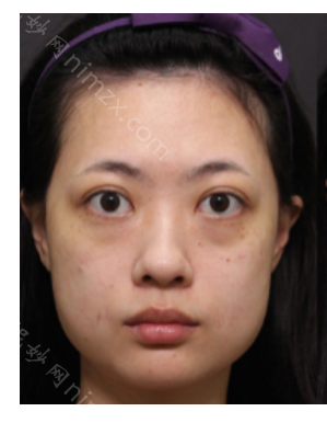 广州欧来美医疗美容医院怎么样?祛眼袋案例前后对比图+价格表