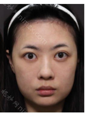 广州欧来美医疗美容医院怎么样?祛眼袋案例前后对比图+价格表