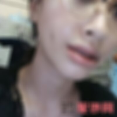 柳州华美医院嘴唇变薄做得好吗