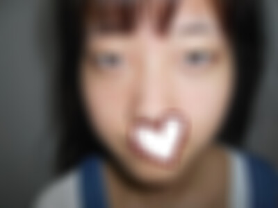 云南华美美莱重度下垂眼修复做得好吗