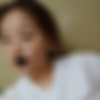 云南华美美莱皮秒祛斑好不好