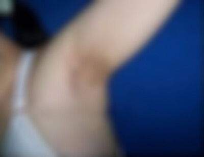 云南华美美莱祛腋臭怎么样