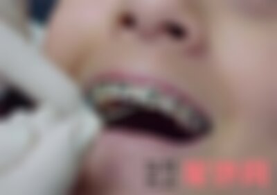 云南华美美莱牙齿矫正多少钱