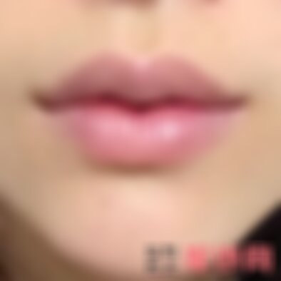云南华美美莱厚唇变薄多少钱