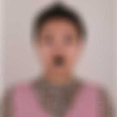 济南海峡整形假体隆鼻做得怎么样