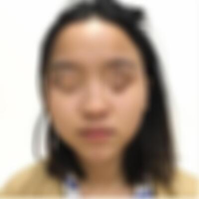 杭州星光丽格医院隆鼻效果如何