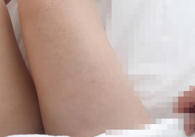 深圳赫思医疗美容是正规医院吗？做激光脱毛行吗，附案例价格表！