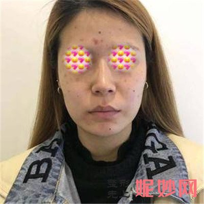 常德伊丽莎白祛痘怎么样