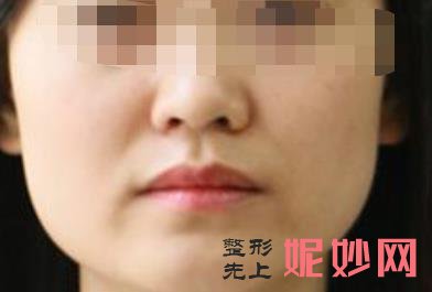 北大口腔梁成怎么样？做颌面整形好不好，附案例和价格表！
