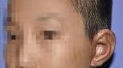 成都耳朵畸形矫正医院哪家好_效果怎么样？附案例！