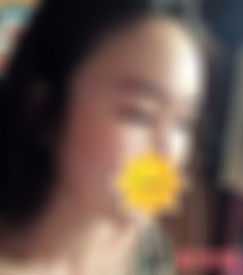 沈阳杏林美容整形医院开眼角怎么样