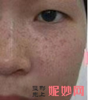 黄金微针做一次有效果吗，这篇文章告诉你答案