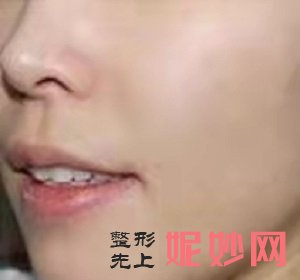 黄金微针做一次有效果吗，这篇文章告诉你答案