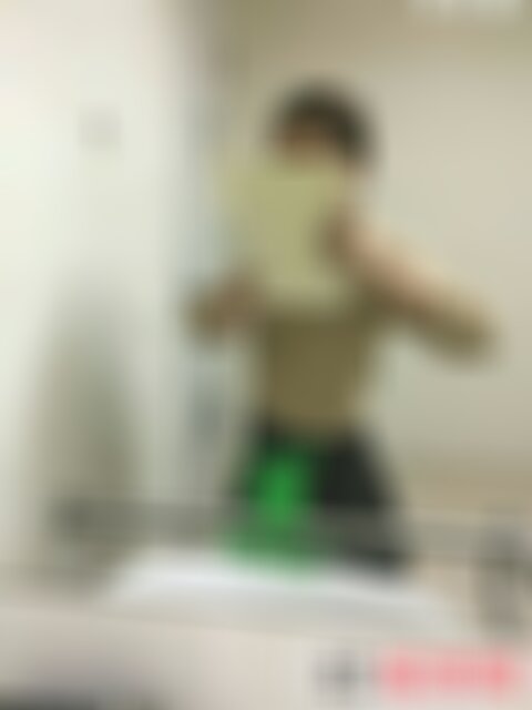 成都铜雀台吸脂瘦身案例