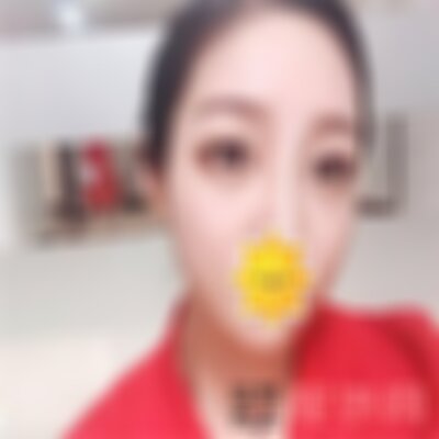 保定华美自体太阳穴填充效果如何