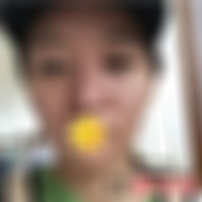 保定华美自体太阳穴填充效果如何