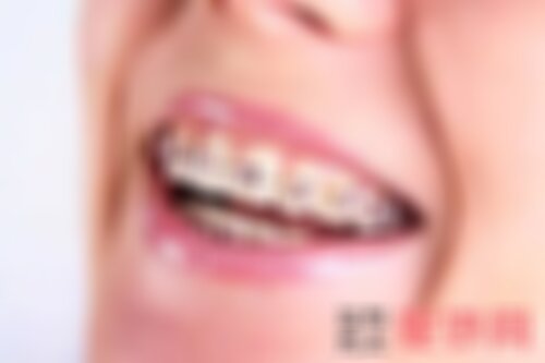 广州曙光美容医院箍牙多少钱