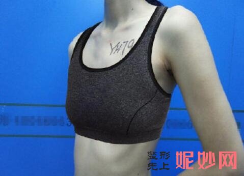 北京新星靓自体脂肪丰胸怎么样