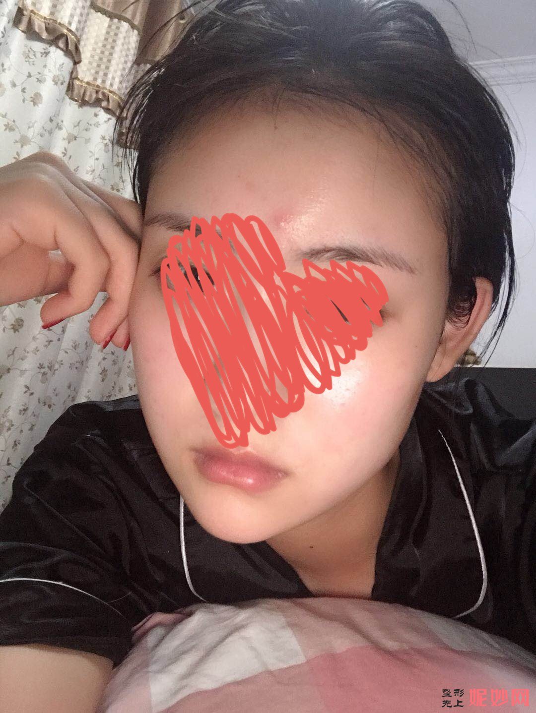 西京医院整形科打瘦脸*多少钱