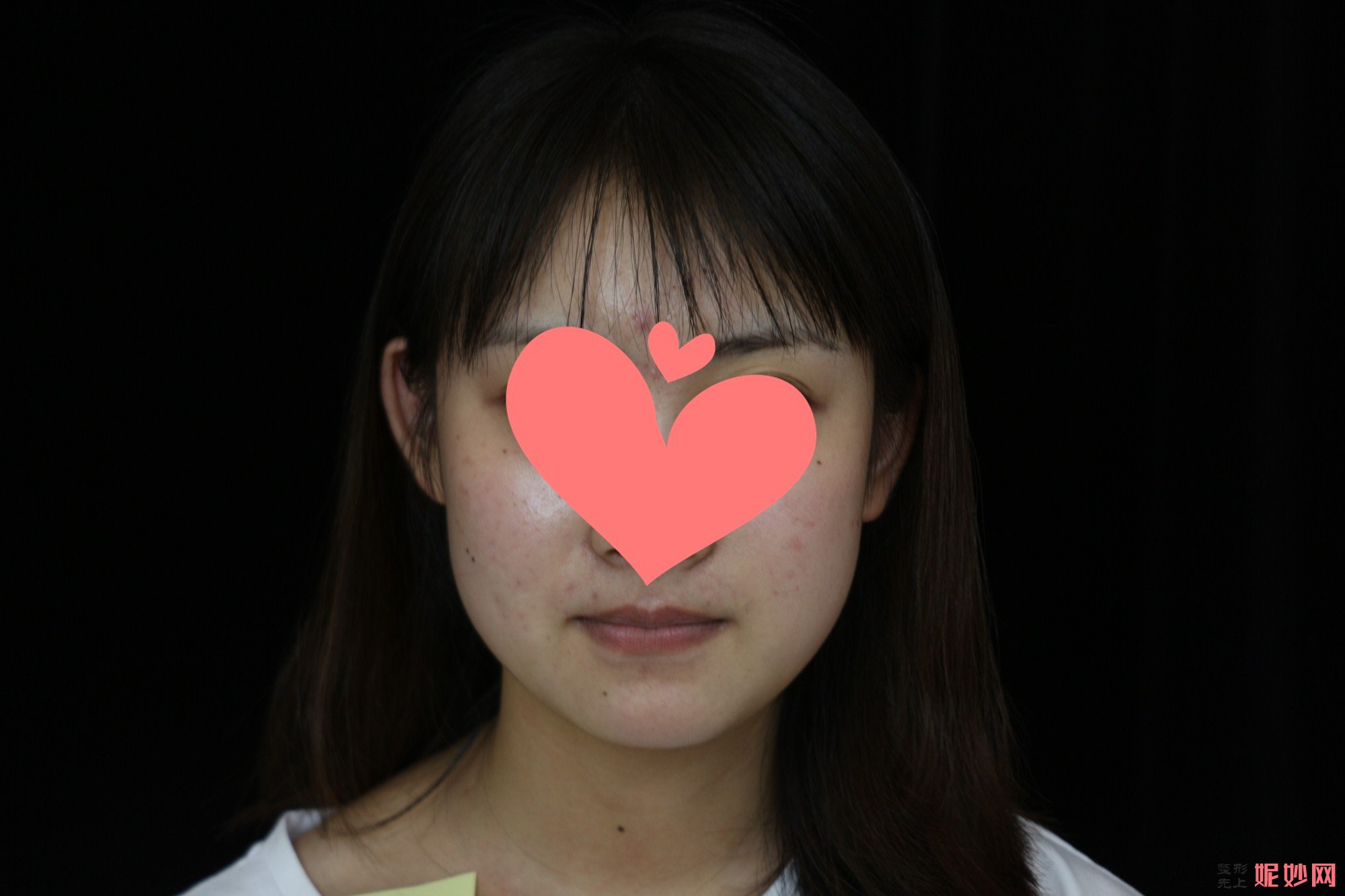 西京医院整形科打瘦脸*多少钱