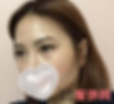 四川娇点颧骨整形怎么样