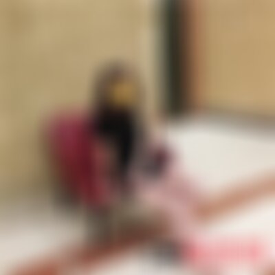 成都艾米丽吸脂案例