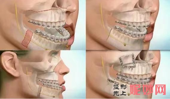 王晓霞正颌手术案例_王晓霞正颌技术怎么样？