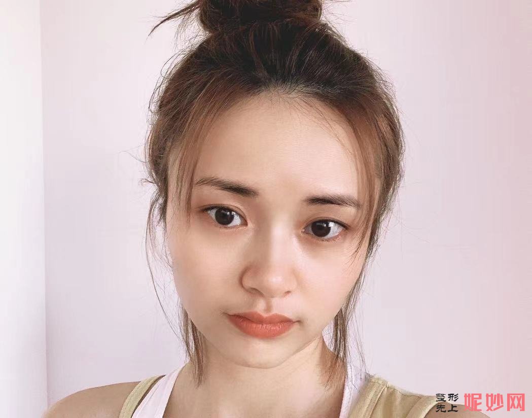 王晓霞正颌手术案例_王晓霞正颌技术怎么样？