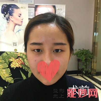 常州美莱做眼综合怎么样