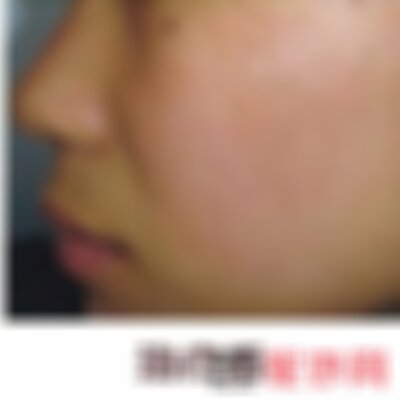 成都军建医院祛色素疤痕怎么样