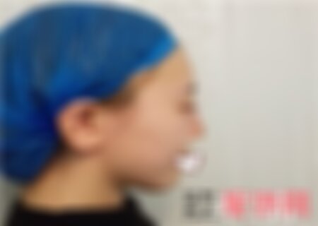 成都天使之翼隆鼻案例