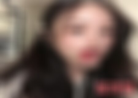 四川美莱双眼皮案例