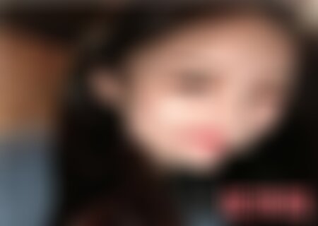 四川美莱双眼皮案例